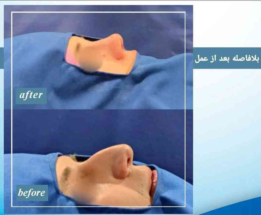 جراحی بینی نیمه فانتزی