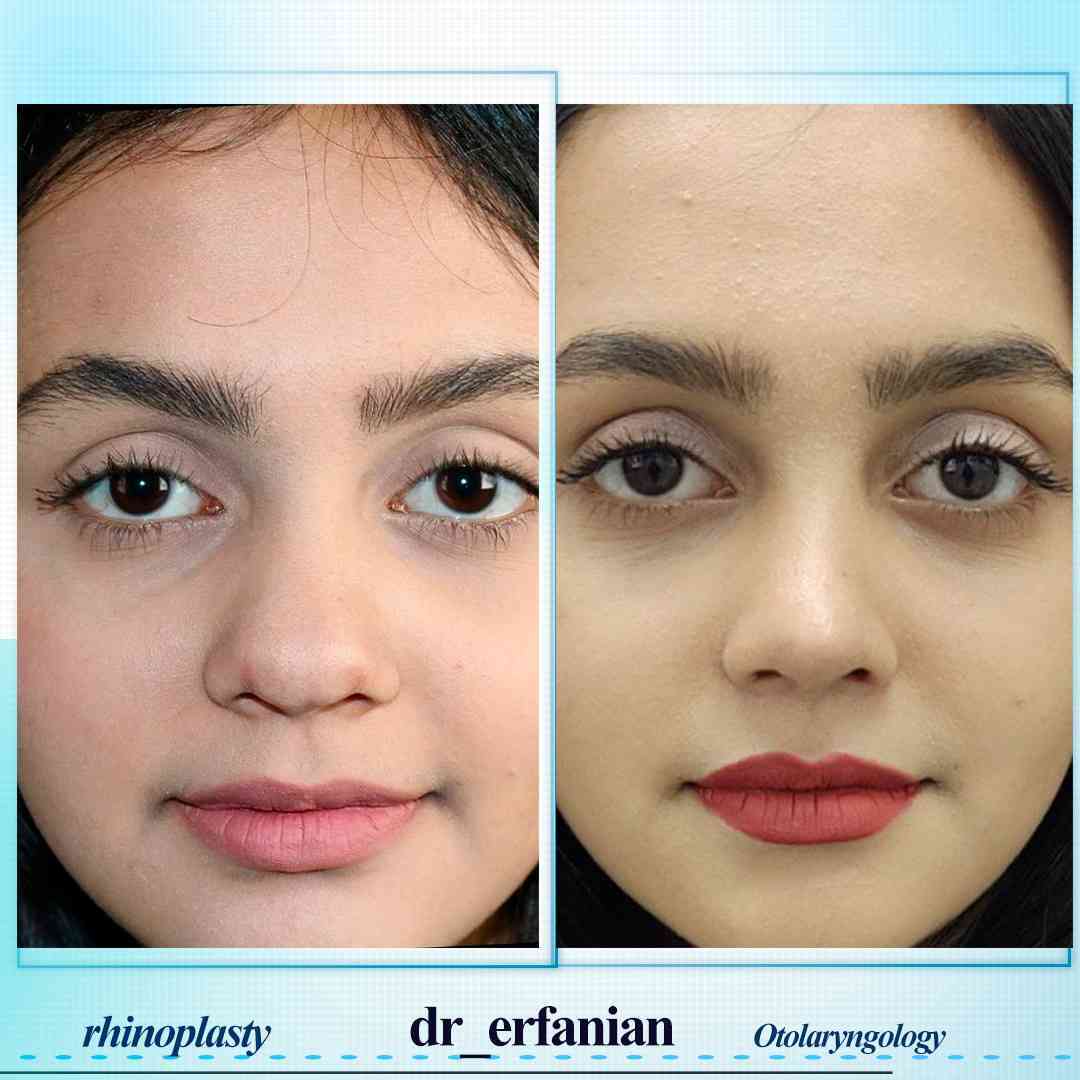 عمل طبیعی بینی